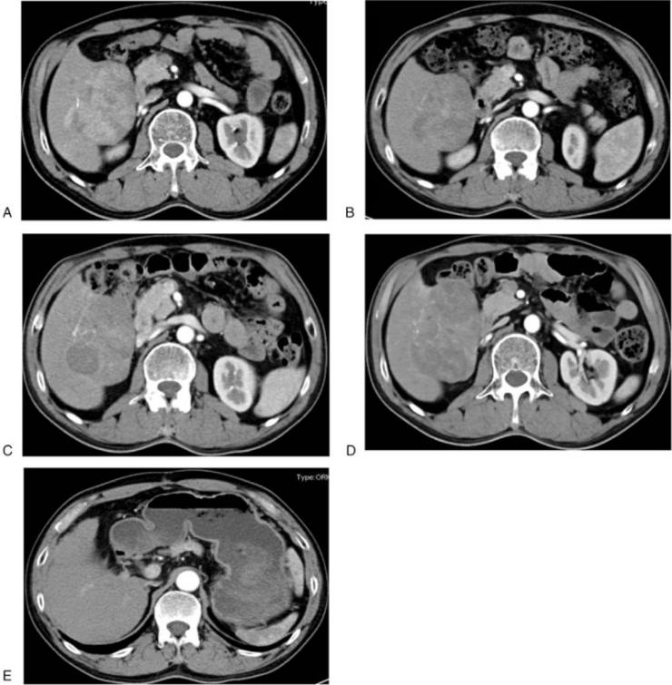 Fig.1 CT scan of liver treated with donafenib.